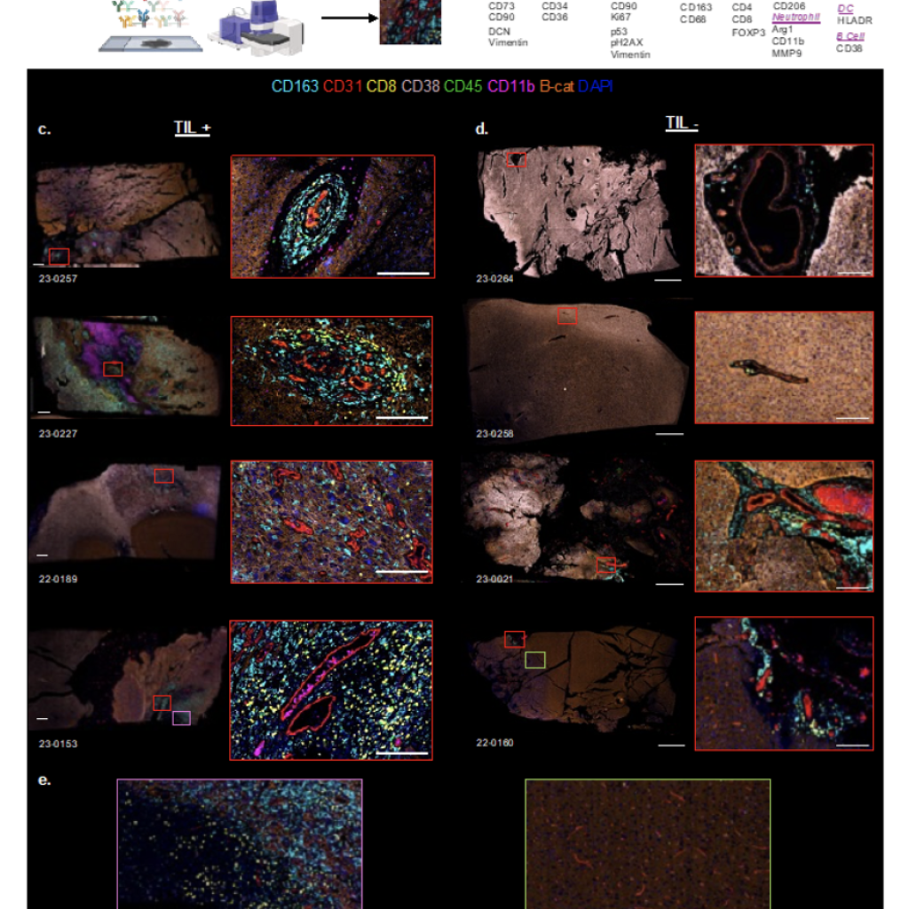 A Spatial Multi-Omic Framework Identifies Gliomas Permissive to TIL Expansion (PREPRINT)